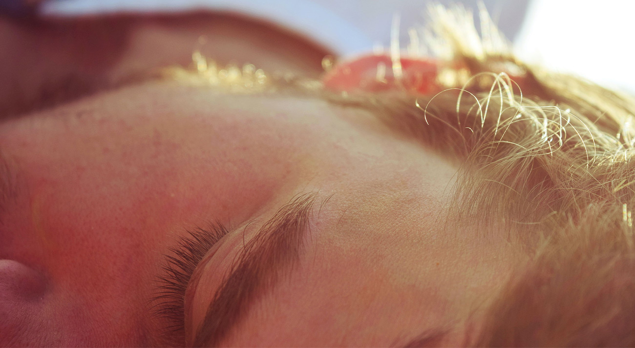 Alopecia de cejas