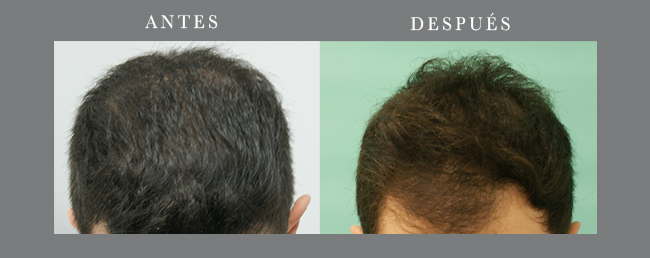 Antes y después caso 1