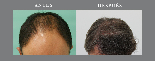 Antes y después caso 2